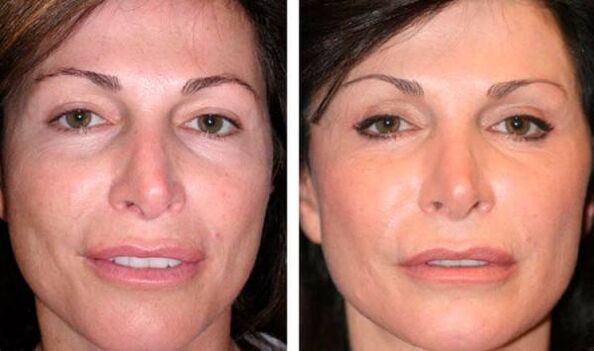 before and after pictures of facial rejuvenation with plasma