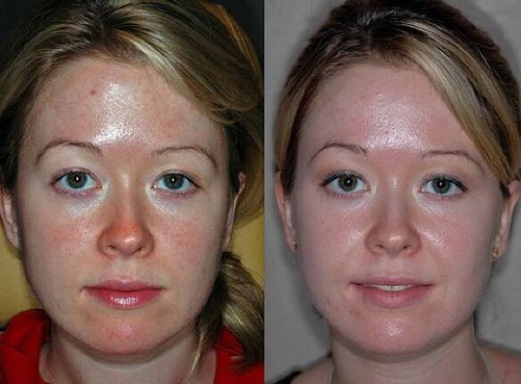 before and after pictures of plasma rejuvenation