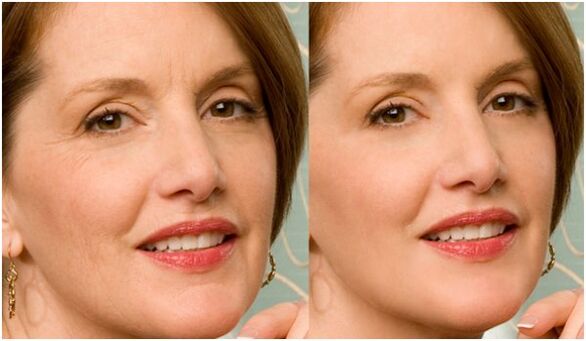 before and after plasma facial rejuvenation