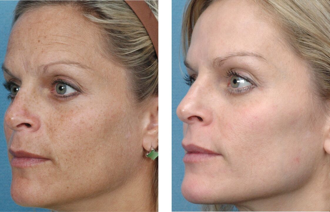 before and after photos of skin rejuvenation 1