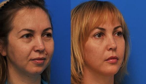 before and after skin rejuvenation with breast tightening photo 1