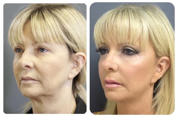 skin rejuvenation before and after photo facelift 2