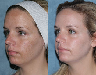 Before after fractional rejuvenation of face