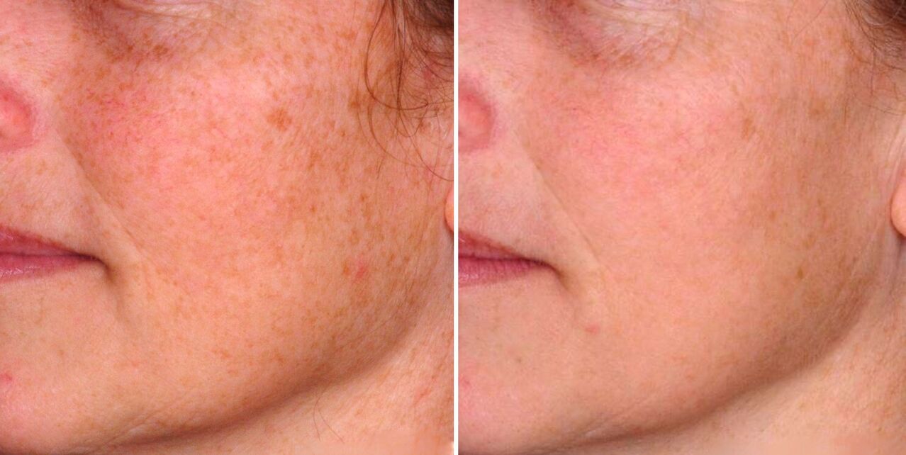 The result of fractional photothermolysis is a reduction in age spots on the facial skin. 