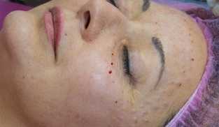 skin recovery after mesotherapy