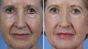 Partial facial rejuvenation before and after photo capture