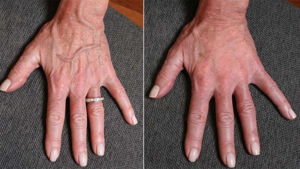 contour resin, hand rejuvenation photo 1 before and after