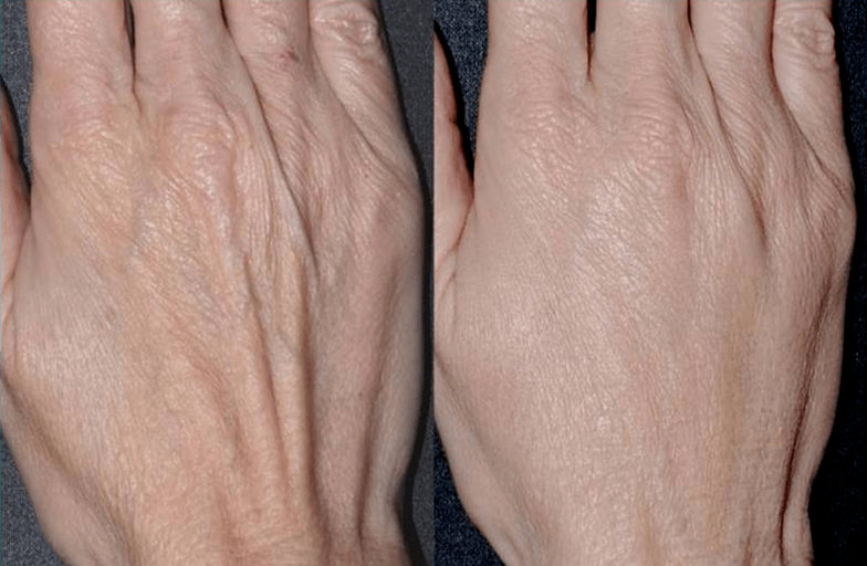 contour resin, hand rejuvenation photo 2 before and after