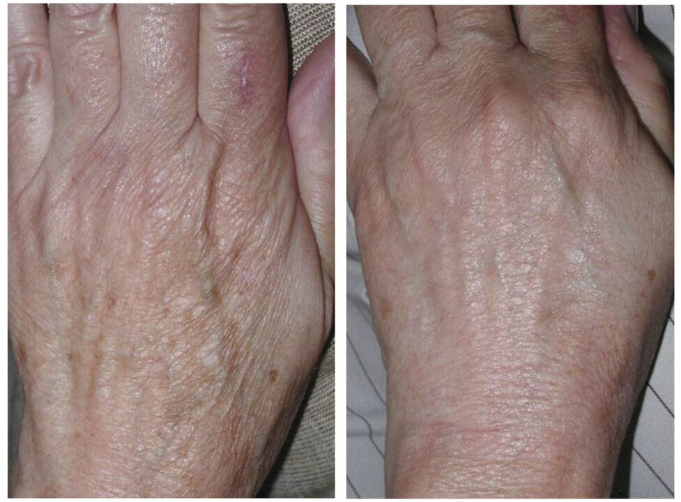 laser hand rejuvenation before and after photography